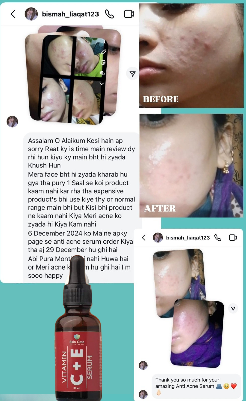 ANTI ACNE & GLOWING SERUM VITAMIN C + E