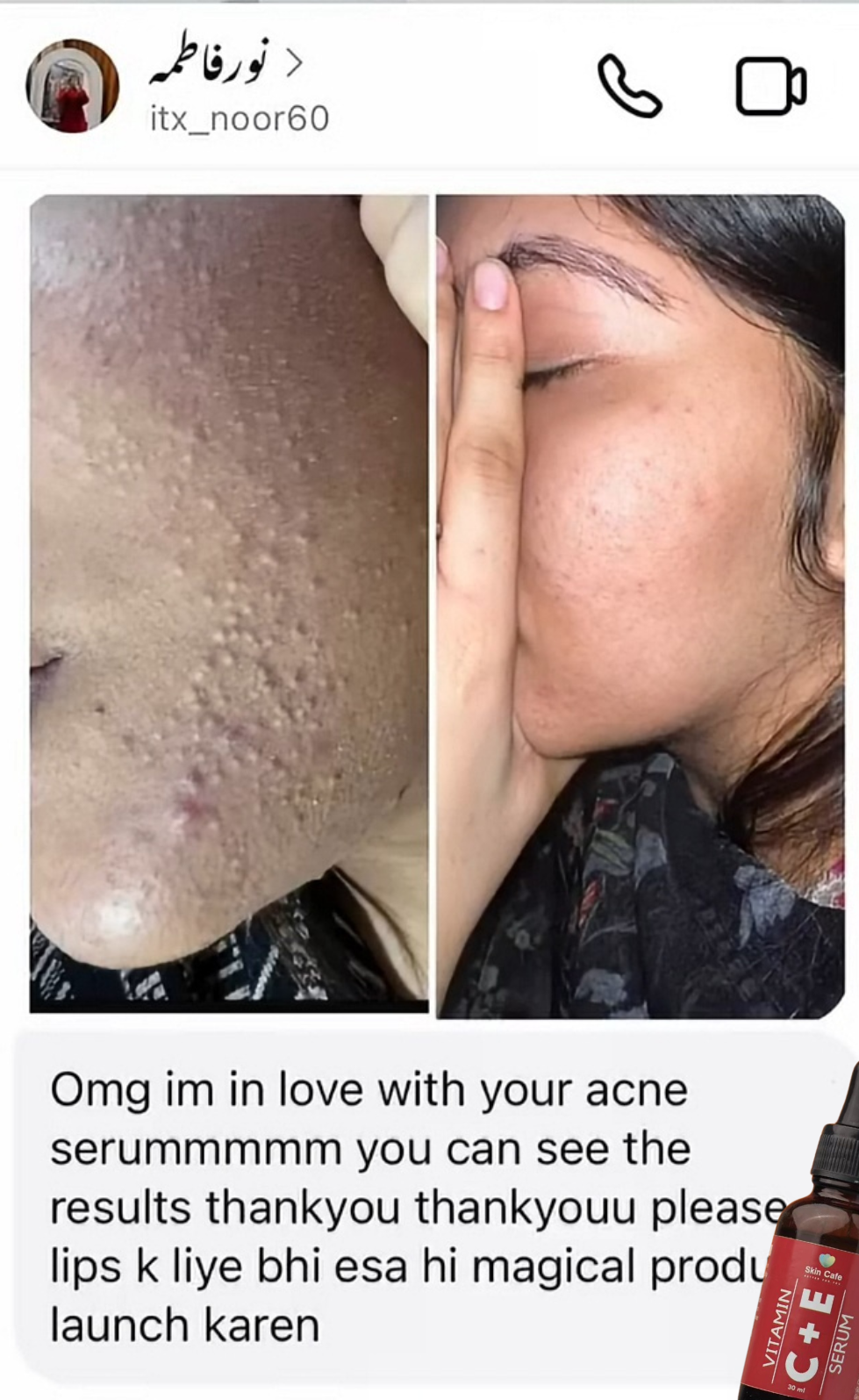 ANTI ACNE & GLOWING SERUM VITAMIN C + E