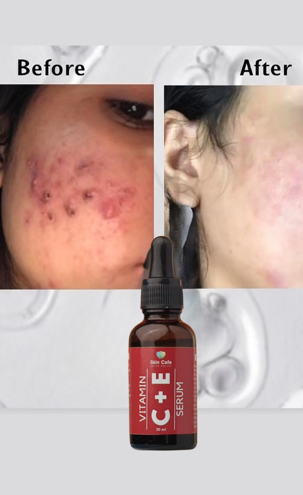 ANTI ACNE & GLOWING SERUM VITAMIN C + E