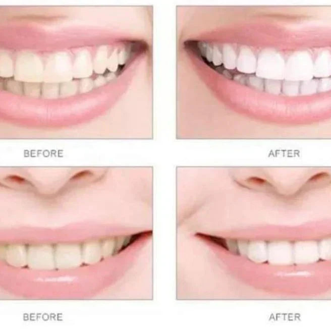 HiSmile V34™ – No More Yellow Stains, Just Bright Smiles