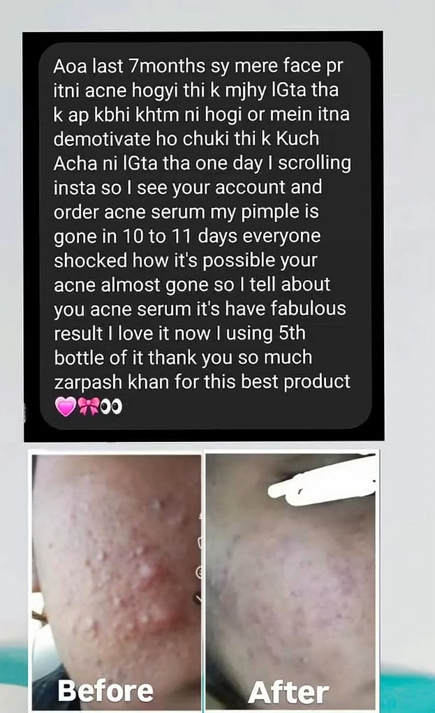 ANTI ACNE & GLOWING SERUM VITAMIN C + E